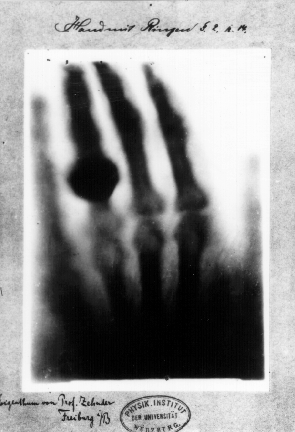 Radiografia da mão de Anna Bertha Roentgen